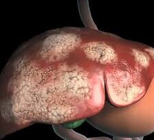 Global Liver Cancer Cases Could Double by 2050, Study Warns