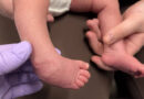 Early Care Key to Preventing Clubfoot Disability