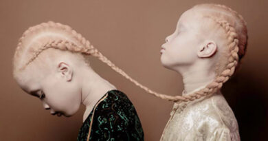 Experts Seek Better Care for Albinos in FCT